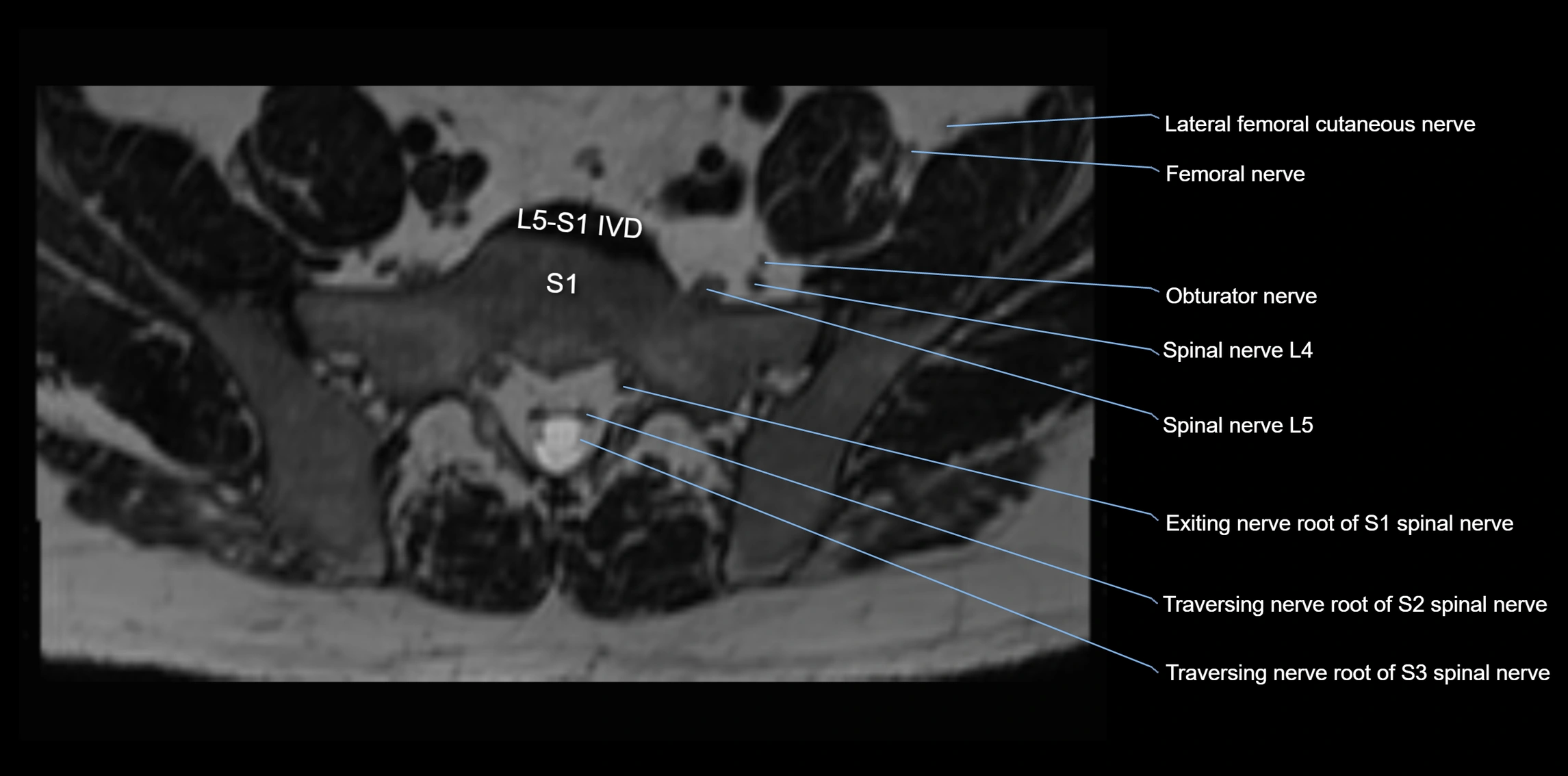 MR lumbosacral plexus axial cross sectional anatomy 3T  radiology  image-img-1008001-00070.webp